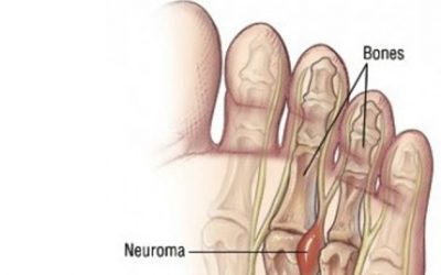 Neuroma de Morton