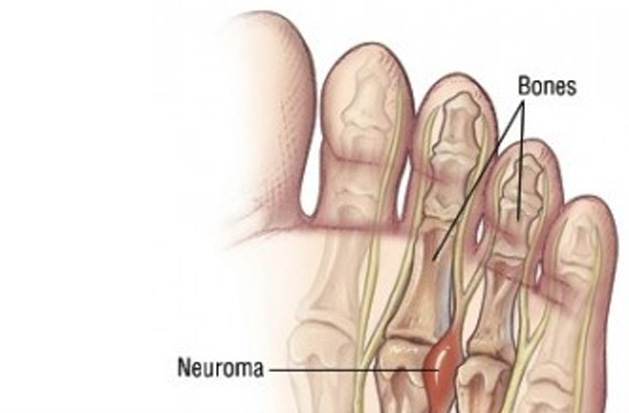 Neuroma de Morton